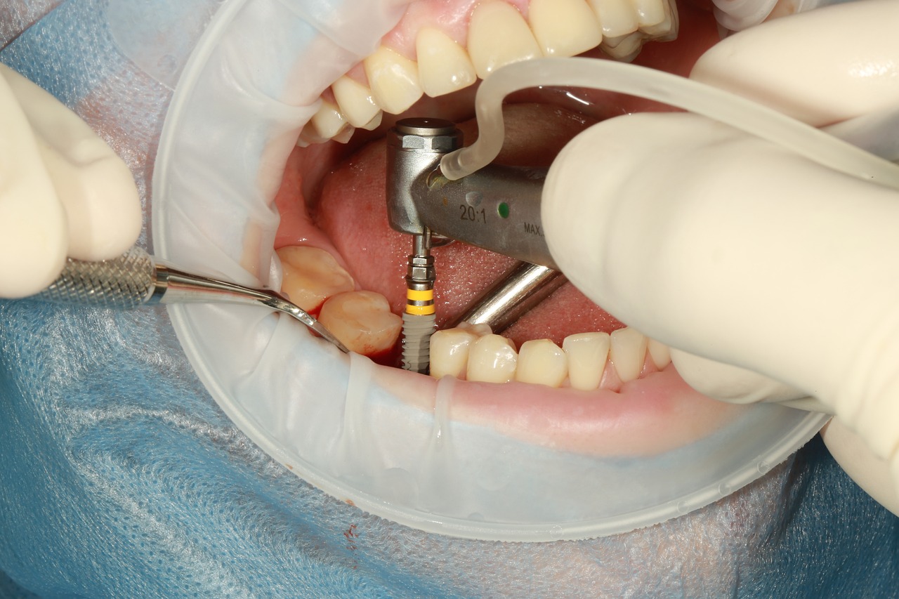 dental, implant, surgery-3754769.jpg